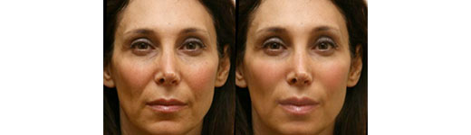 juvederm